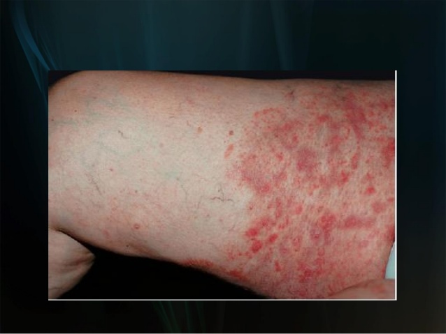 Nấm nông ở chân - Hình ảnh minh họa